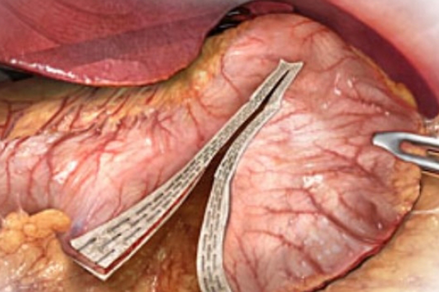 Resultados de la Gastrectomia Vertical Laparoscópica*