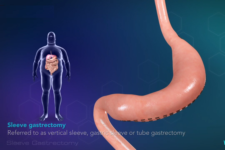 Cirugía para la diabetes
