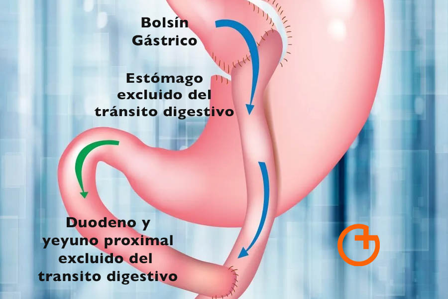 La cirugía gástrica provoca déficit de vitamina B12
