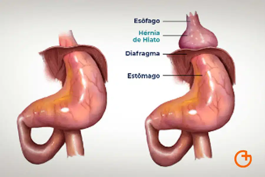 blog obesidad en Mallorca hernia de hiato