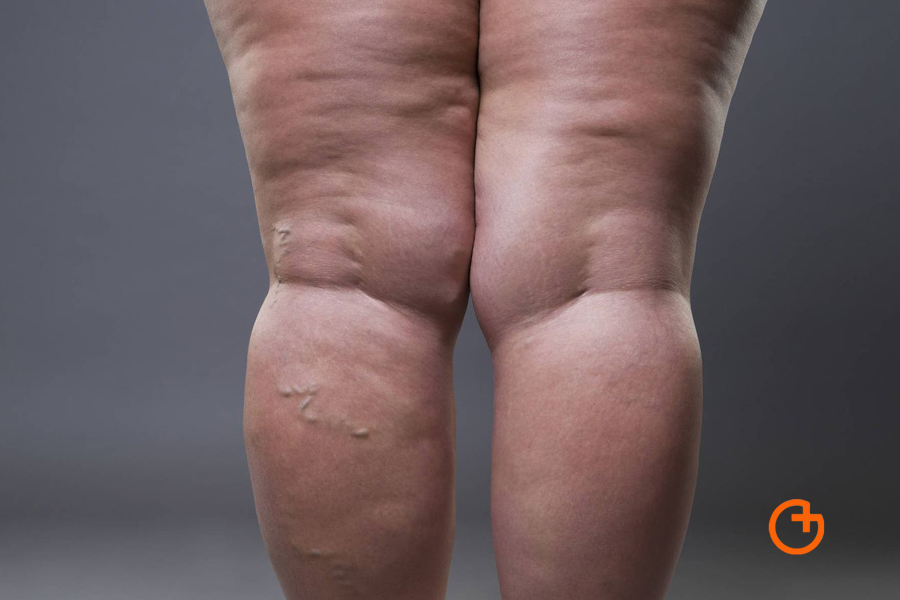 La retención de líquidos tiene causas en enfermedades comunes