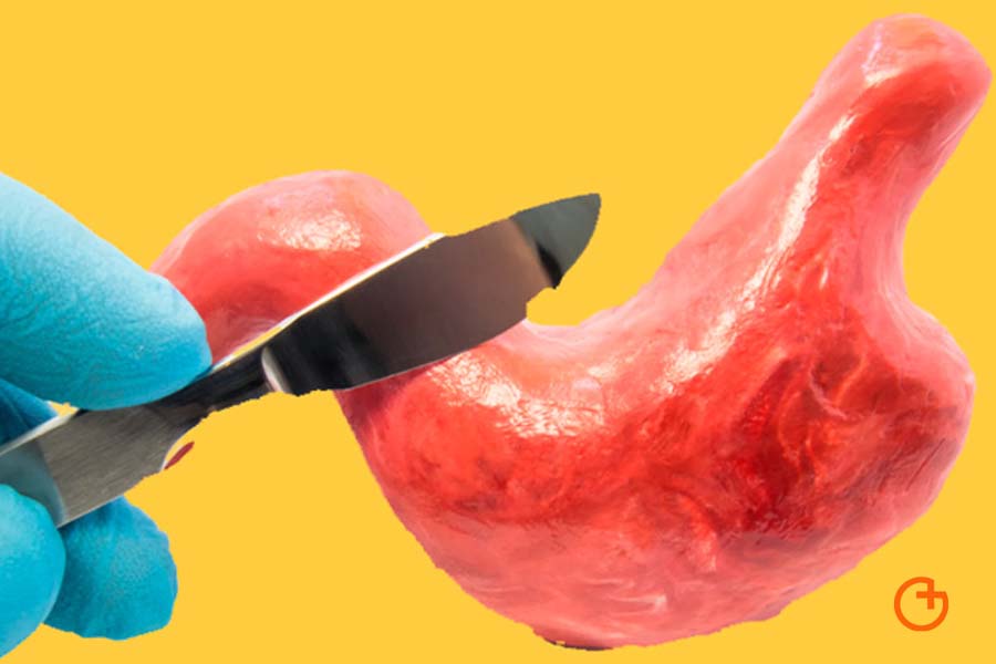 En la reducción gástrica por cirugía ¿Es vital el volumen del estómago? 