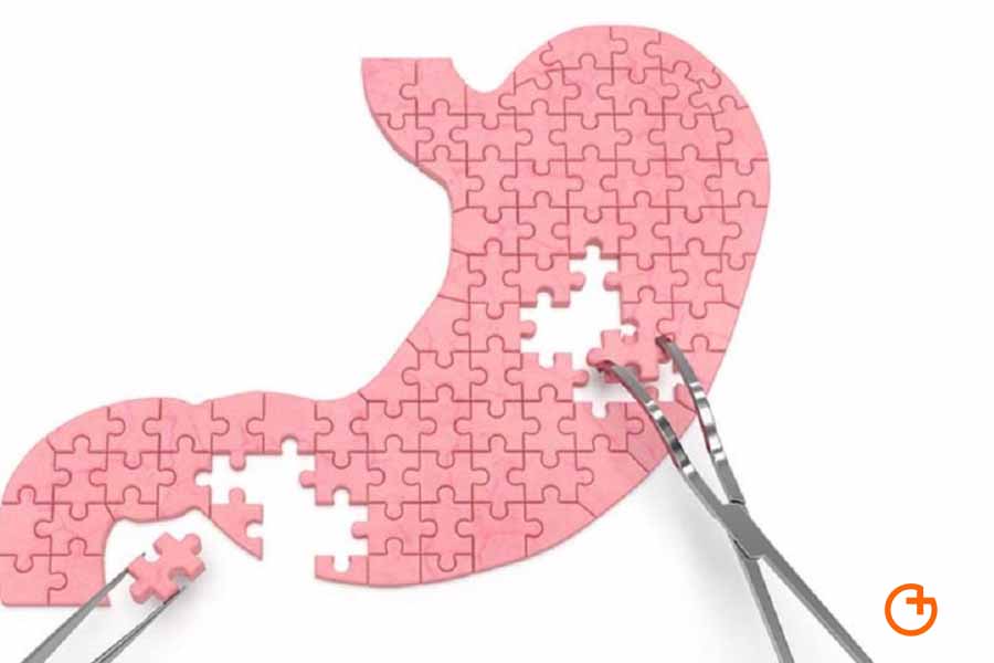 cirugia metabólica en la diabetes