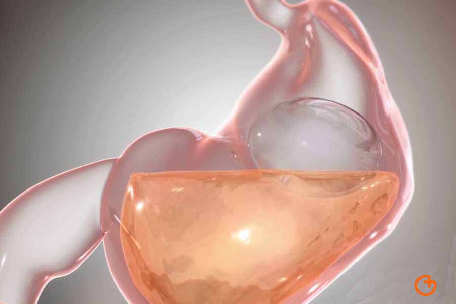 Absorción de las bebidas con alcohol tras la cirugía de la obesidad