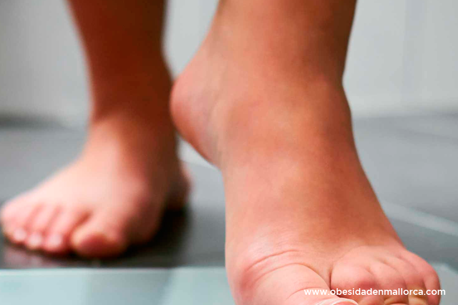 Modificar los hábitos de vida tras la cirugía bariátrica reduce el peso entre un 20 y 40%