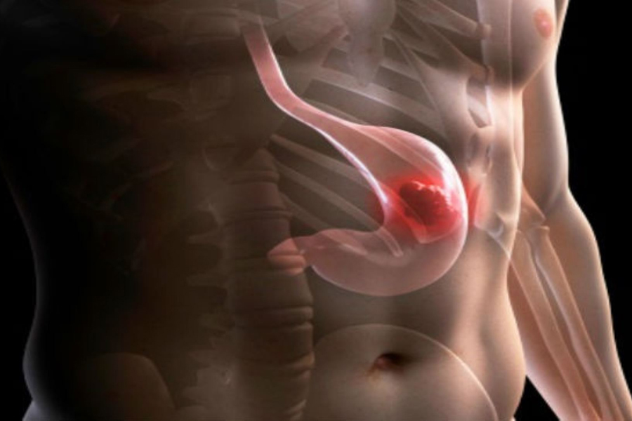 Balón intragástrico