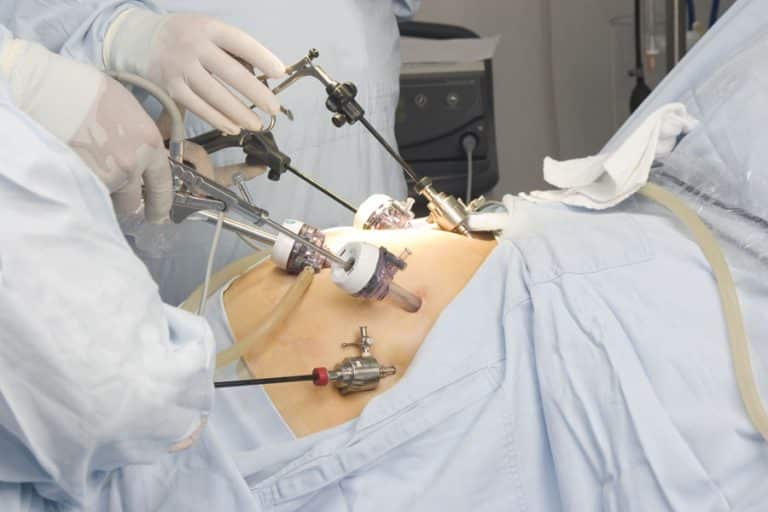 cirugia laparoscopica en obesidad