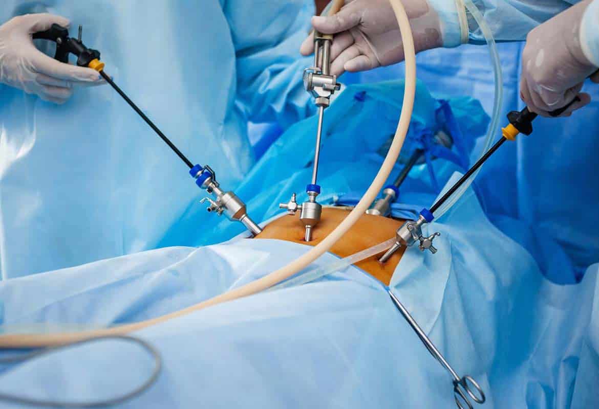 cirugia por laparoscopia