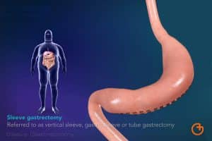 la manga gastrica o gastrectomia vertical es la tecnica más usada en la cirugia de la obesidad
