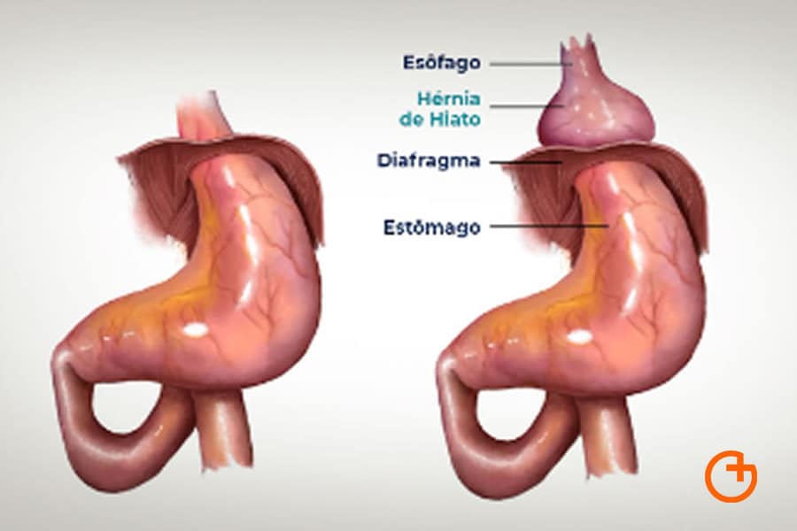 blog-obesidad-en-mallorca-hernia-hiato